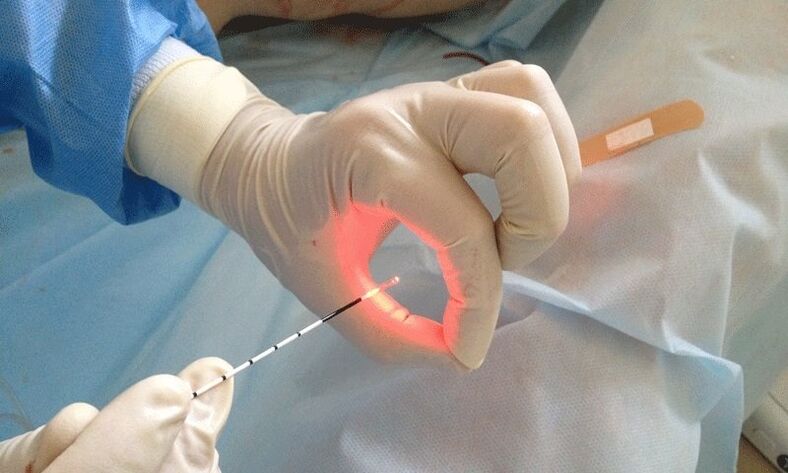 tratament cu laser pentru prostatita