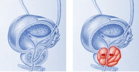 prostată sănătoasă și inflamată cu prostatită